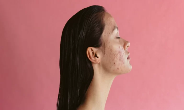 5 Common Skincare Mistakes That Can Cause Acne Flare-Ups
